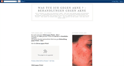 Desktop Screenshot of gegen-akne.blogspot.com