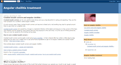 Desktop Screenshot of angular-cheilitis-treatment.blogspot.com