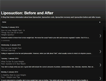 Tablet Screenshot of liposuctionbeforeandafter1.blogspot.com