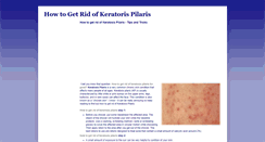 Desktop Screenshot of howtogetridofkeratosispilaris.blogspot.com