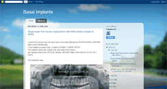 Desktop Screenshot of basalimplants.blogspot.com