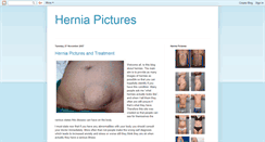 Desktop Screenshot of hernia-pictures.blogspot.com