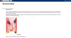 Desktop Screenshot of hemorroides2.blogspot.com