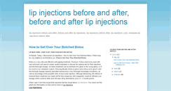 Desktop Screenshot of lipinjectionsbeforeandafter.blogspot.com