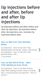 Mobile Screenshot of lipinjectionsbeforeandafter.blogspot.com