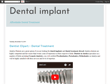 Tablet Screenshot of dentalimplanttry.blogspot.com