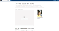 Desktop Screenshot of cureeczematips.blogspot.com