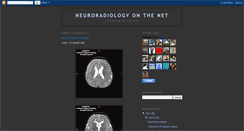 Desktop Screenshot of neuroradiologyonthenet.blogspot.com