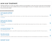 Tablet Screenshot of about-acne-scar-treatment.blogspot.com