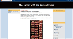 Desktop Screenshot of damon-braces.blogspot.com