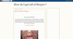 Desktop Screenshot of howdoigetridofherpes.blogspot.com