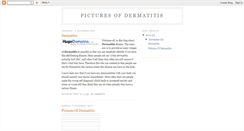 Desktop Screenshot of dermatitis-pictures.blogspot.com