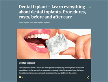 Tablet Screenshot of dental-inplants.blogspot.com