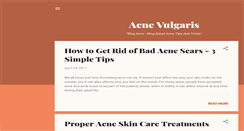 Desktop Screenshot of acne-vulgaris-causes.blogspot.com