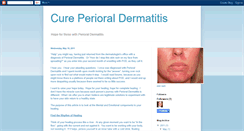 Desktop Screenshot of cureperioraldermatitis.blogspot.com