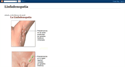 Desktop Screenshot of linfadenopatia.blogspot.com