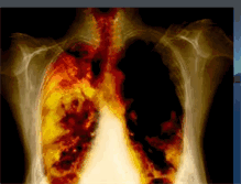 Tablet Screenshot of parcancerpulmonar.blogspot.com