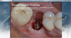 Desktop Screenshot of dentalimplanttraining.blogspot.com