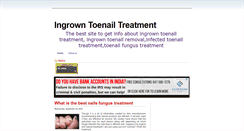 Desktop Screenshot of ingrowntoenailtreatment123.blogspot.com