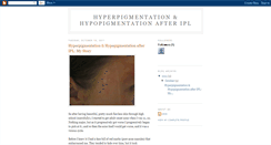 Desktop Screenshot of hypopigmentationipl.blogspot.com