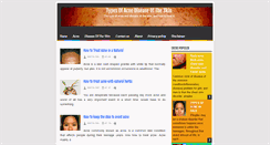 Desktop Screenshot of abouttypes-of-acne.blogspot.com