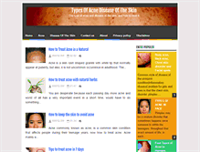 Tablet Screenshot of abouttypes-of-acne.blogspot.com