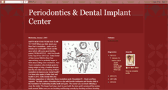 Desktop Screenshot of bloomingtondentalimplants.blogspot.com