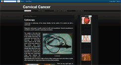 Desktop Screenshot of cancer-cervi-x.blogspot.com