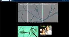 Desktop Screenshot of cromomicosis-chromoblastomicosis.blogspot.com