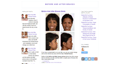Desktop Screenshot of beforeandafterbraces.blogspot.com