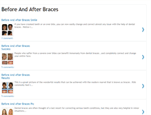 Tablet Screenshot of beforeandafterbraces.blogspot.com