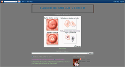 Desktop Screenshot of cancerdecuellouterino-rogelio.blogspot.com