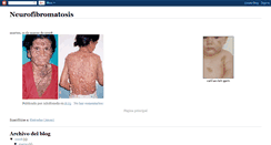 Desktop Screenshot of neurofibromatosis22.blogspot.com