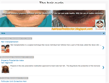 Tablet Screenshot of hairlossfinddoctor.blogspot.com