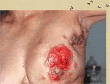 Tablet Screenshot of canceracurabledisease.blogspot.com