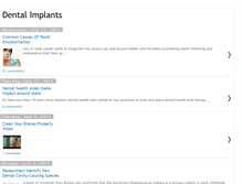 Tablet Screenshot of dentalimplantsnew.blogspot.com
